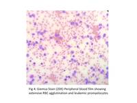 Microgranular acute promyelocytic leukemia with hyperleukocytosis and autoimmune hemolysis 4