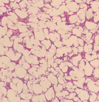 Adrenal Myelolipoma 1