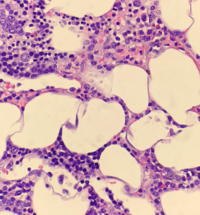 Adrenal Myelolipoma 4