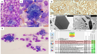 Crystal-storing histiocytosis