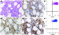 Biphenotypic plasma cell myeloma