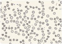 Dapsone poisoning