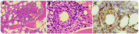 Ring-shaped granulomas on bone marrow found in a returning traveler with fever of unknown origin