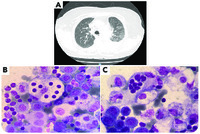 Unusual histiocytes in a pleural effusion: signature of a rare disease