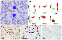 Giant intracytoplasmic inclusions in a T-cell large granular lymphocytic leukemia patient with acute severe anemia