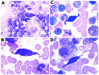 Abnormal mast cells in myeloid neoplasm with eosinophilia and PDGFRB rearrangement