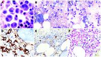 Posttransplant lymphoproliferative disorder: EBV plasma cell myeloma with large multinucleated plasma cells