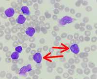 Cup-like blasts  in AML
