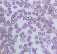 Hemoglobin C