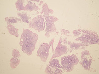 Indolent-Tcell-Lymphoproliferative-Disorder-HE-Low-Power