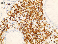 Promyelocytic leukemia with basophil-like granules