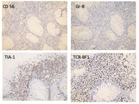 Indolent T-cell Lymphoproliferative Disorder: CD56, Gr-8, TIA-1, & TCR-BF1