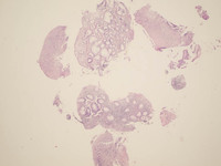 Indolent-Tcell-Lymphoproliferative-Disorder-HE-Low-Power