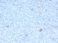 CD30 positive Reed- Sternberg cells