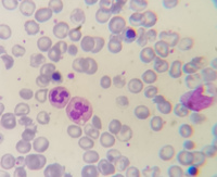 Thalassemia major case with Howell-jolly bodies and increased NRBC 3