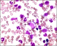 Wuchereria Bancrofti with CML in Accelerated Phase 1