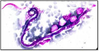 Wuchereria Bancrofti with CML in Accelerated Phase 2