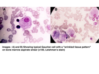 GAUCHER'S CELLS IN BONE MARROW ASPIRATE SMEARS