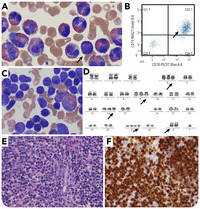 Hyperdiploid B-lymphoblastic Leukemia/lymphoma With Hypereosinophilia ...