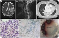 Verruconis gallopava in a patient with myelofibrosis on ruxolitinib