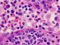 Mast cell infiltrate; H&E; 1000X oil objective.