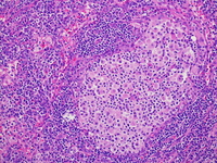 Histiocytes with emperipolesis; H&E; 200X objective.