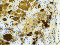 S100 immunostain; 400X objective.