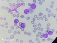 Myeloblast with cup-like invaginations