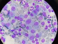 Plasma Cell in case of Plasma Cell Myeloma 6