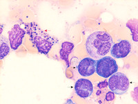 AML with inv(16)- Bone Marrow Aspirate