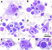 Hemophagocytic lymphohistiocytosis in SARS-CoV-2 infection