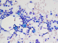 Therapy-related Myeloid Neoplasm- Bone marrow Aspirate 1