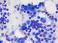 Therapy-related Myeloid Neoplasm- Bone marrow Aspirate 2