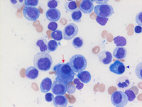 Therapy-related Myeloid Neoplasm- Bone marrow Aspirate 4