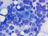 Therapy-related Myeloid Neoplasm- Bone marrow Aspirate 5