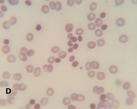 Blood findings in DIC (Scorpion sting)