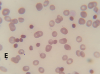 Blood findings in DIC (Scorpion sting)