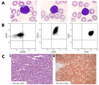 A splenic lymphoma/leukemia with a spontaneous blast decrease without treatment