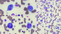 Myeloma- bone marrow aspirate