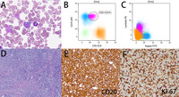 Clonally-unrelated Richter syndrome: diffuse large B-cell lymphoma arising in a patient with chronic lymphocytic leukemia/smalllymphocytic leukemia