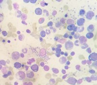 Bone marrow picture in a patient with Visceral Leishmaniasis 1