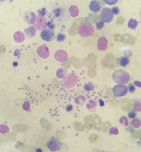 Bone marrow picture in a patient with Visceral Leishmaniasis 2