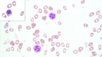Megaloblastic anemia