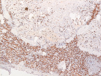 Littoral cell angioma- CD8