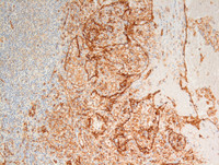 Littoral cell angioma- CD31