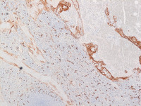 Littoral cell angioma- CD34