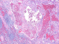 Littoral cell angioma- HE