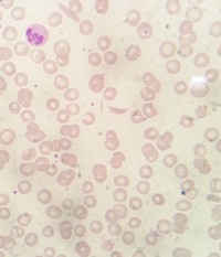 Typical RBC morphology in Sickle β Thalassemia 1