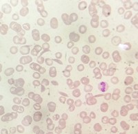 Typical RBC morphology in Sickle β Thalassemia 2