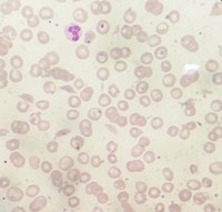 Typical RBC morphology in Sickle β Thalassemia 3